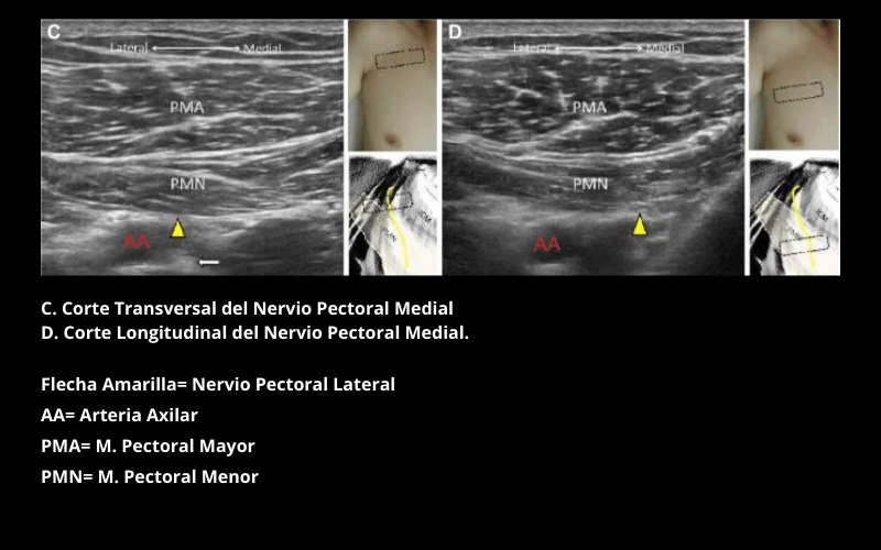 Nervio Pectoral Medial (1).png